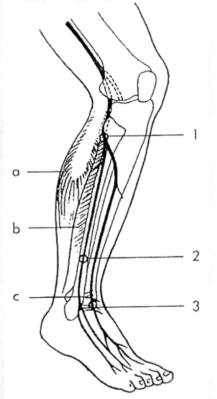 Úžiny a místa komprese n.peroneus
Úžiny:
1 – peroneální tunel (pod vazivovým začátkem m. peroneus longus),
2 – r. superficialis (průstup fascií bérce),
3 – přední tarzální tunel.
Svaly:
a – m. triceps surae,
b – m. peroneus longus,
c – ligamentum 