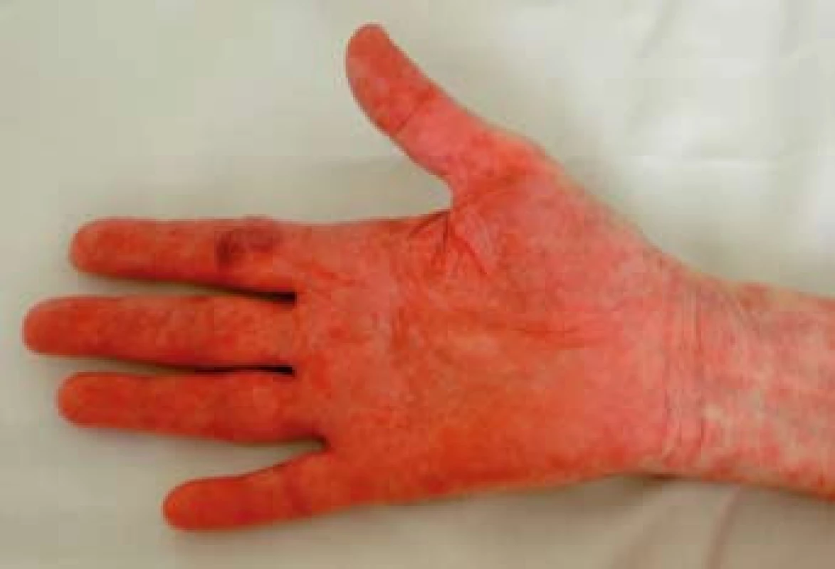 Mokvající eroze na dlaních.
Fig. 3. Peeling exanthem on the palms.