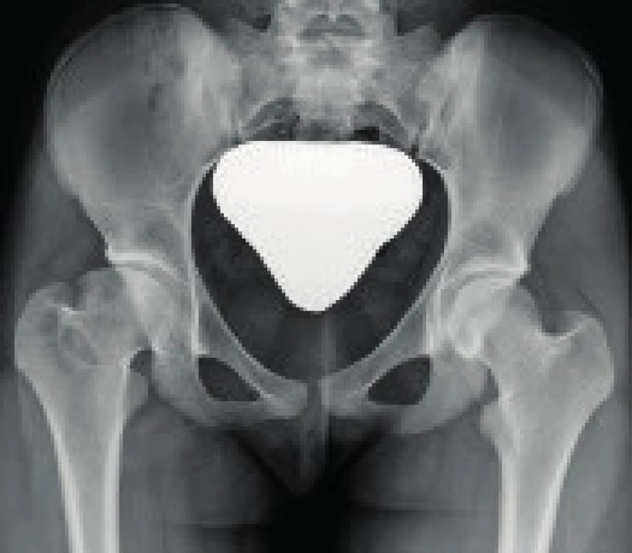 Pacientka s deformitou hlavice vpravo po konzervativně léčené Perthesově chorobě.
Fig. 1. Patient with femoral head deformity following conservative treatment of Perthes disease.