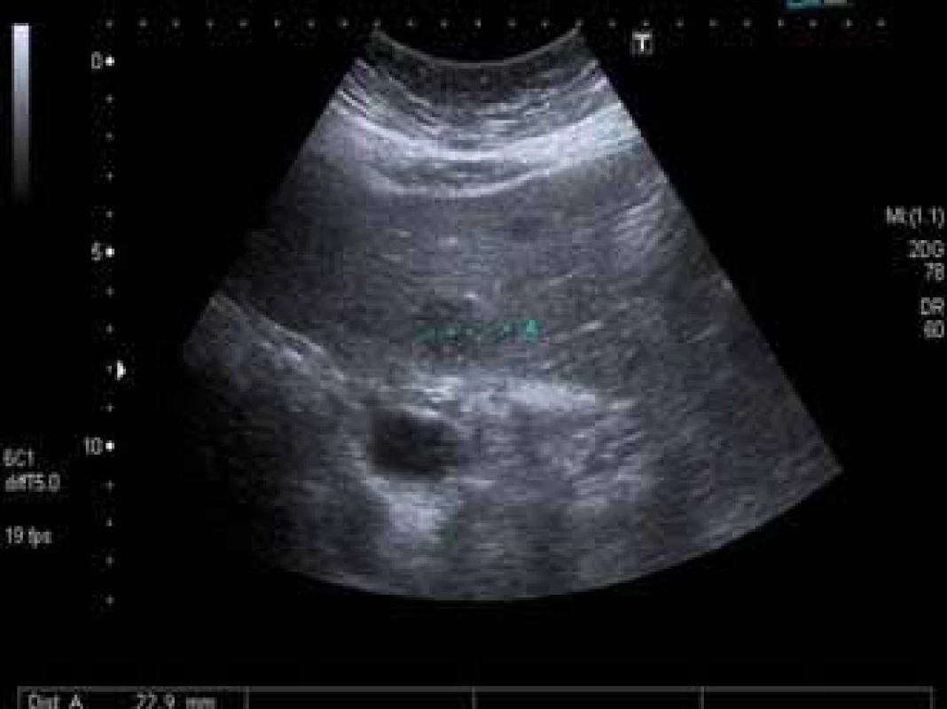 Ložisko lymfomu v játrech. Ultrazvukové vyšetření jater prokazující hypoechogenní ložisko velikosti 22 mm.
Fig. 1. Lymphoma in the liver. Ultrasound showing a hypoechogenic mass of 22 mm in diameter