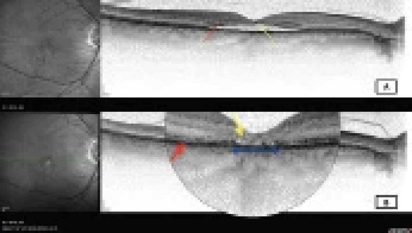 Transfoveolární lineární sken optické koherenční tomografie (Heidelberg Spectralis, Myslík Manethová) 61letého pacienta s chronickou centrální serózní chorioretinopatií zobrazující:
