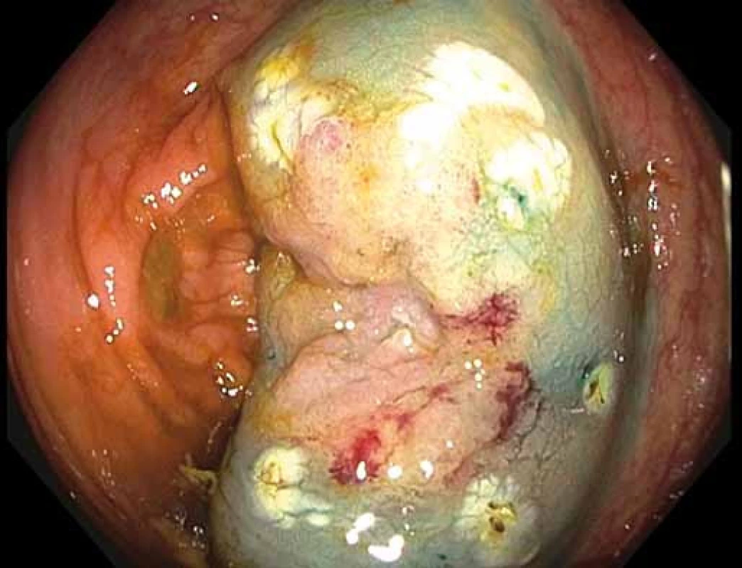 Příznak „non-liftingu“ v centru léze po submukózní injekci fyziologického roztoku s metylenovou modří.
Fig. 3. Non-lifting sign of the centre of the lesion after submucosal injection of saline with methylene blue.