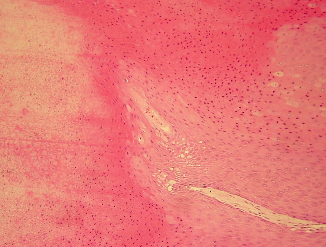 Přechod akantotické epidermis do hmoty rohu, histologický nález, hematoxylin/eozin, 100x.