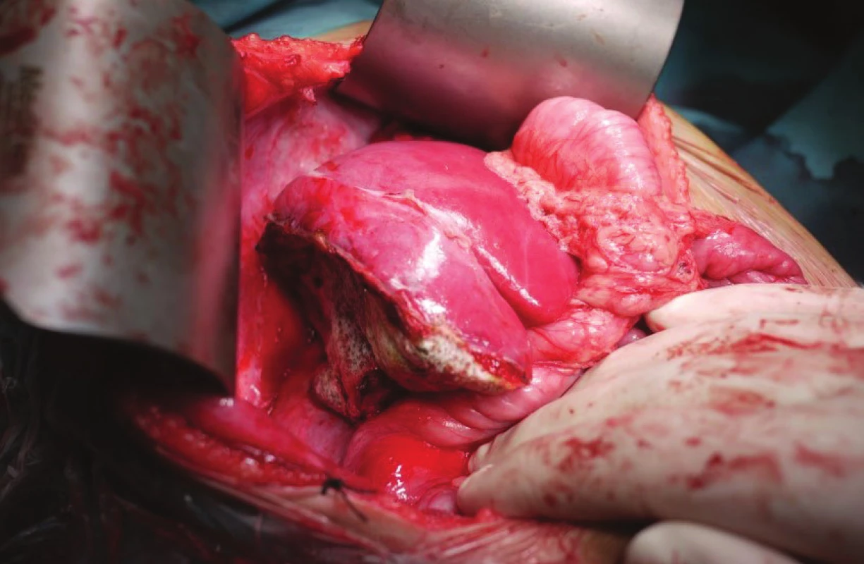 Resekčná plocha ošetrená Tachosilom<sup>TM</sup>
Fig. 2 Resection surface covered with Tachosil<sup>TM</sup>