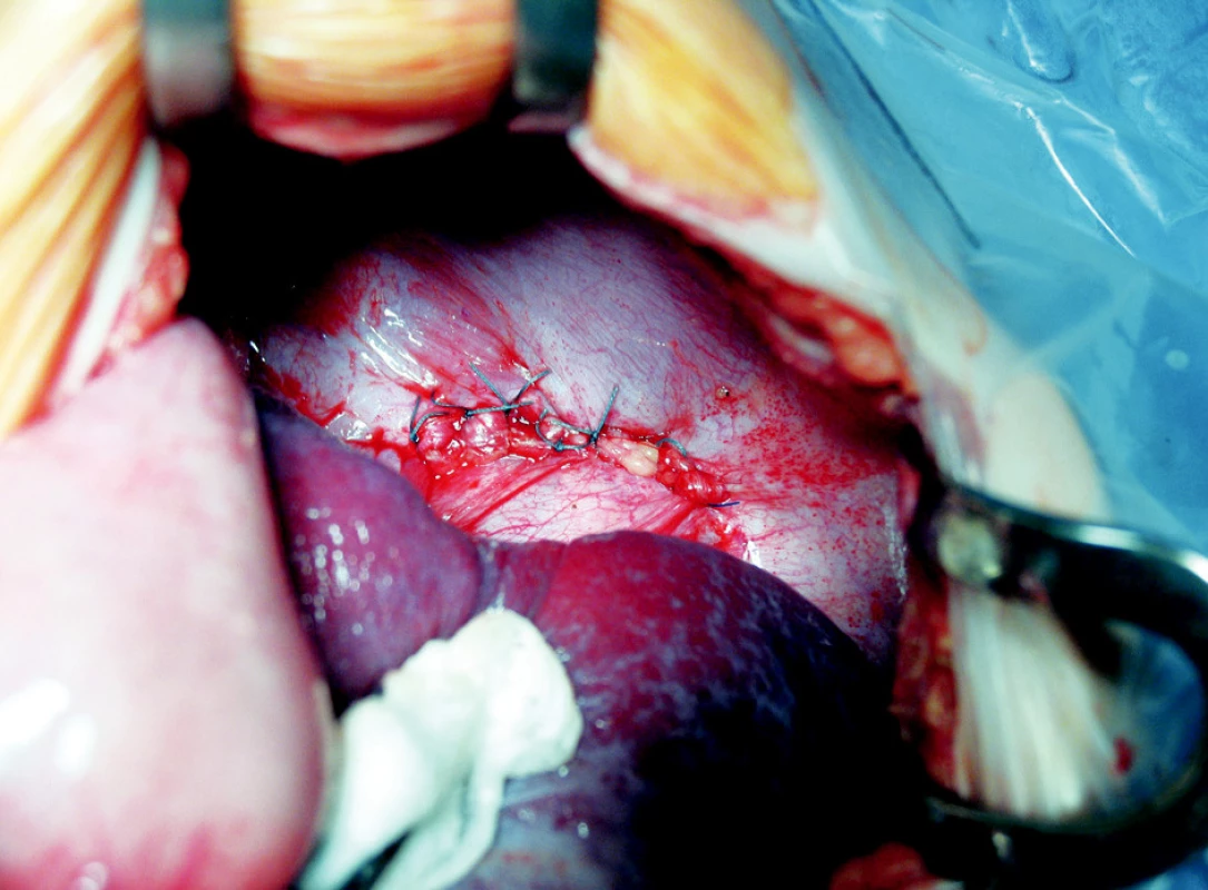 Plastika bránice jednotlivými stehmi bez použitia záplaty
Fig. 2. Diaphragm reconstruction using individual stitches, without a patch