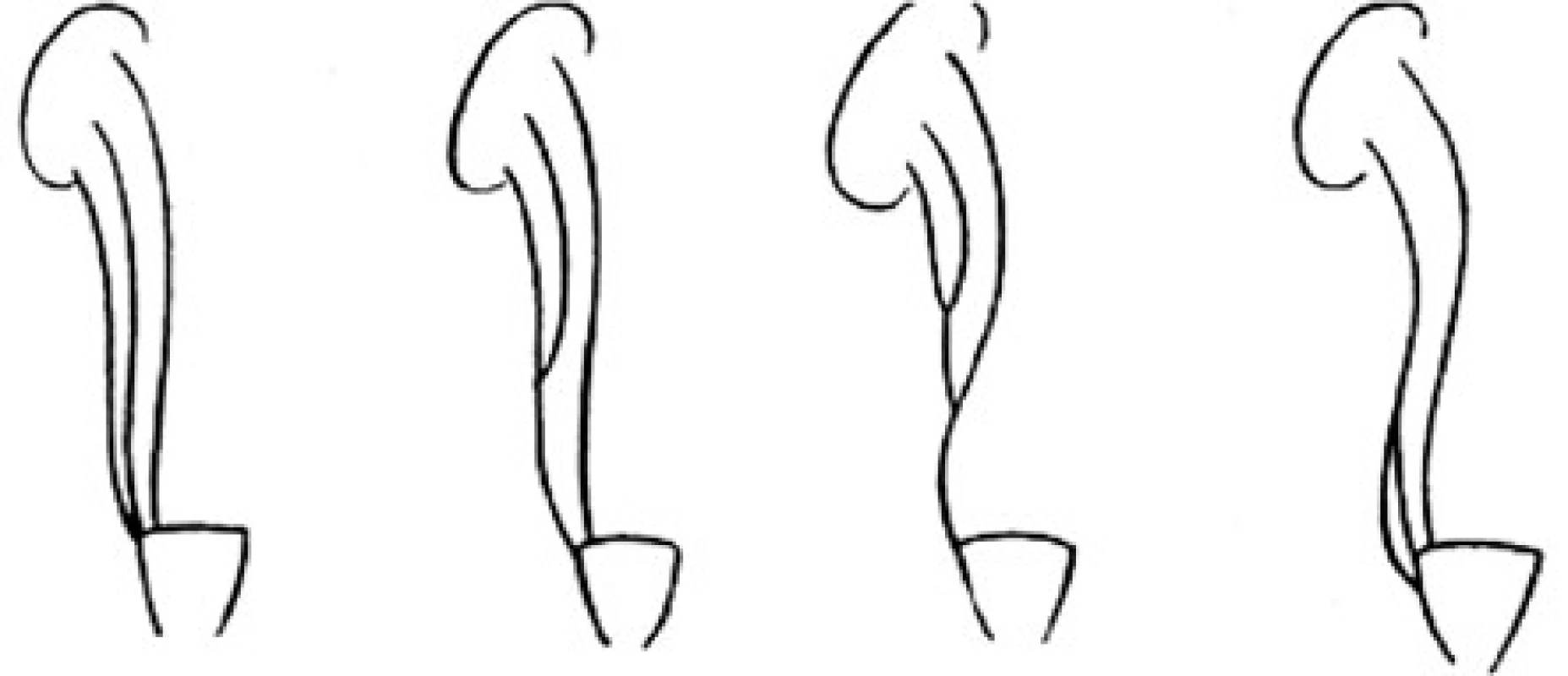<i>Smithova klasifikácia triplikácie močovodu</i>
Fig. 5. <i>Smith’s classification of ureteral triplication</i>