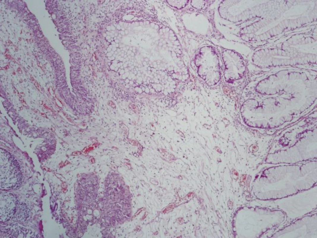 Sliznice močového měchýře vlevo kryta urotelem, vpravo intestinální metaplazie s pohárkovými buňkami (hematoxylin-eosin, zvětšení 40x)
Fig. 4. Bladder mucosa on the left side covered with normal urothelium, right intestinal metaplasia with goblet cells (hematoxylin-eosin, 40x)