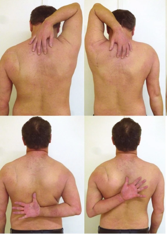 Functional result (Pt 4) in three-part glenoid fossa fracture with separation in the anatomical neck