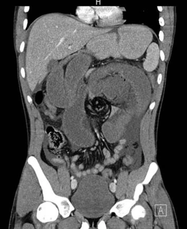 Koronální CT ukazující vírovité stočení mesenteria (whirl sign)
Fig. 2: Coronal CT – the swirling appearance of the mesentery known as the whirl sign