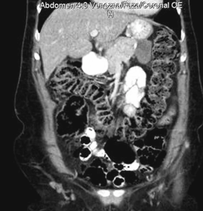 Ohraničená kolekcia za žalúdkom 3 mesiace po operácii
Fig. 5. Defined collection behind the stomach, 3 month after the procedure