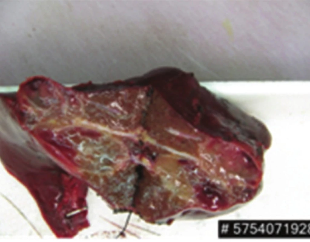 Resekát jater – levostranná hemihepatektomie s dvěma metastázami
Fig. 6: Liver specimen – left hemihepatectomy with two metastases