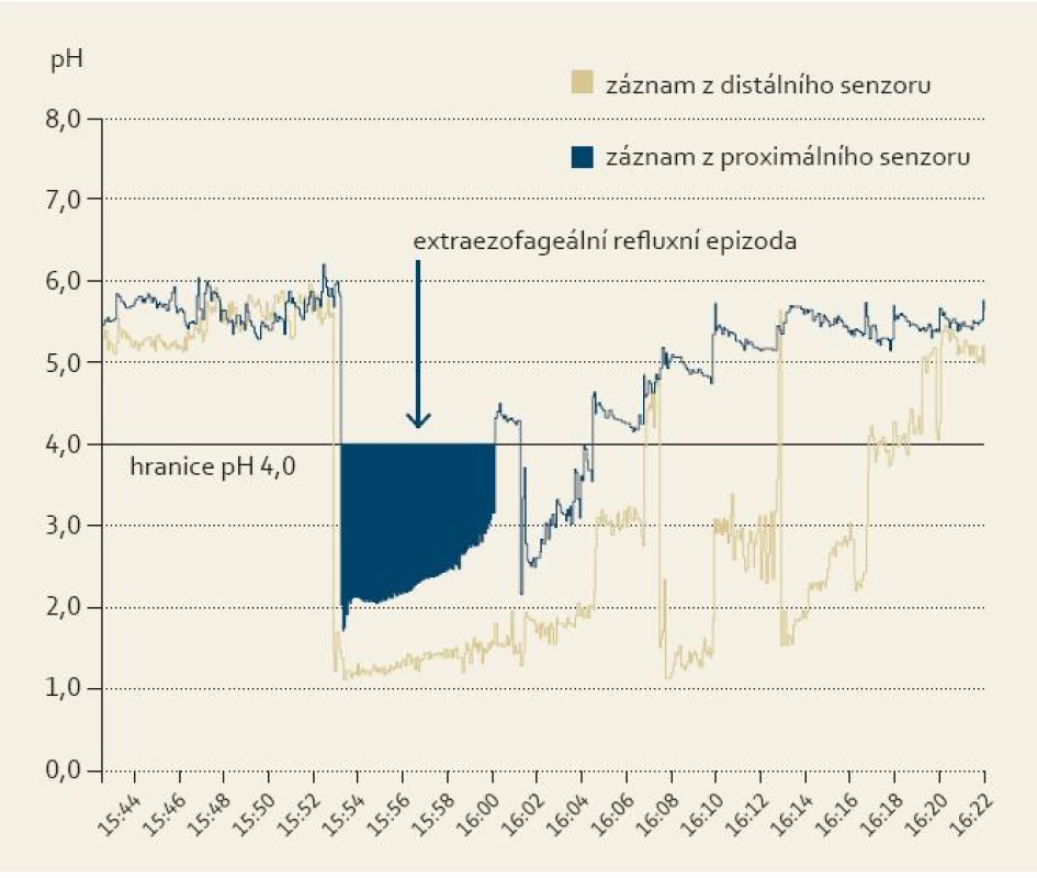Extraezofageální refluxní epizoda zaznamenaná při 24hodinové dvoukanálové ph-metrii s proximálním senzorem umístněným nad úrovní horního jícnového svěrače. popis je přímo v obrázku.
Fig. 3. Extra-esophageal reflux episode recorded during 24-hour double-channel pH-metry with a proximal sensor located above the level of the upper esophageal sphincter. The description is displayed in the figure.