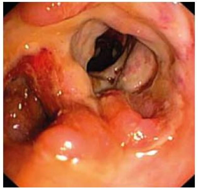 Závažný nález kontinuálnej ulcerácie celej sliznice s hlbokými defektmi sliznice (colon ascendens).
Fig. 5. Serious finding of continuous ulcerations of the entire mucosa with deep defects of mucosa (colon ascendens).
