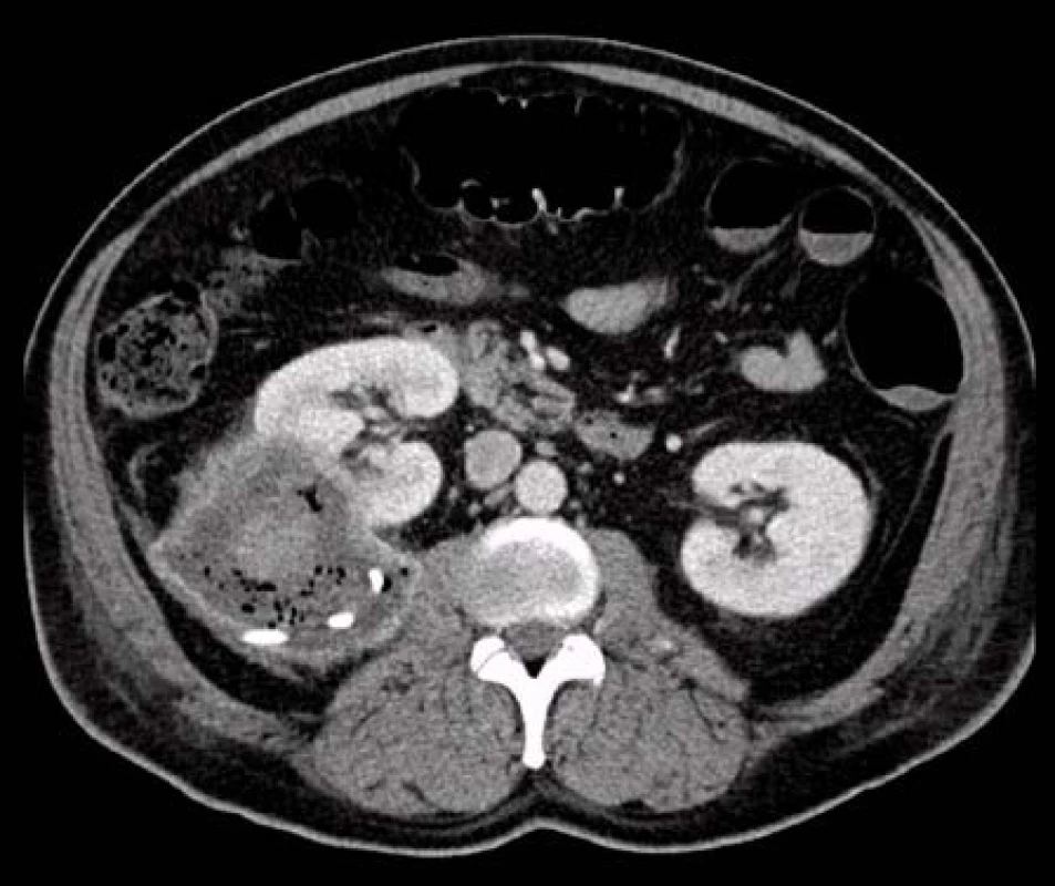 CT: axiální řez cystickým ložiskem pravé ledviny po drenáži
Fig. 3. CT: axial section at the level of the cystic lesion of the right kidney after drainage
