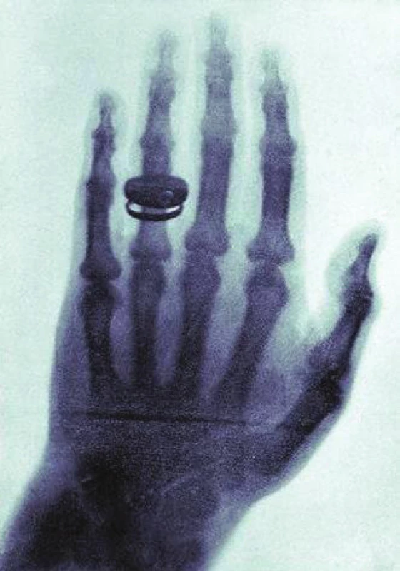 <i>Prosvícená ruka Röntgenovy ženy z ledna roku 1896.</i>