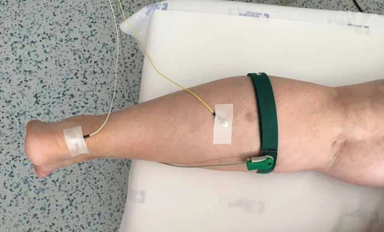 V rutinní diagnostické praxi se pro vybavení H-reflexu užívá poloha vleže na břiše.
Fig. 1. The patient is lying in the prone position when the H-reflex is elicited in everydaydiagnostic practice.