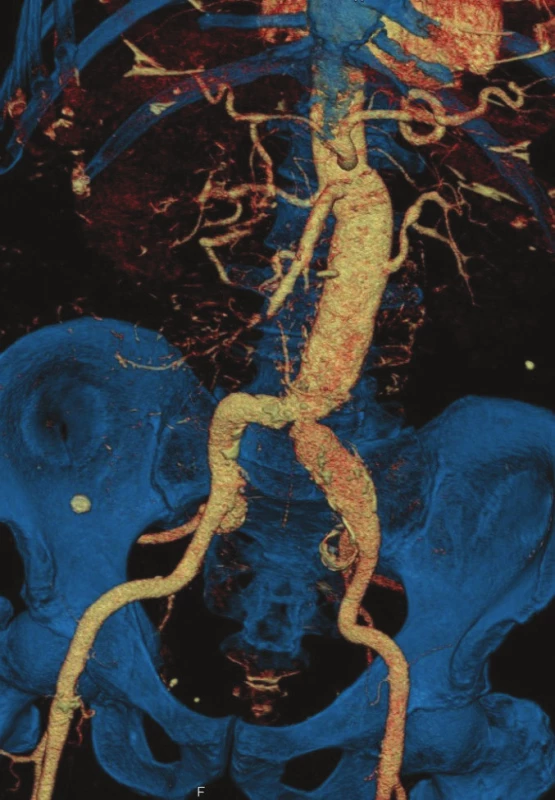 CTA kontrola po roce od výkonu
Fig. 4: Follow-up CTA one year after surgery
