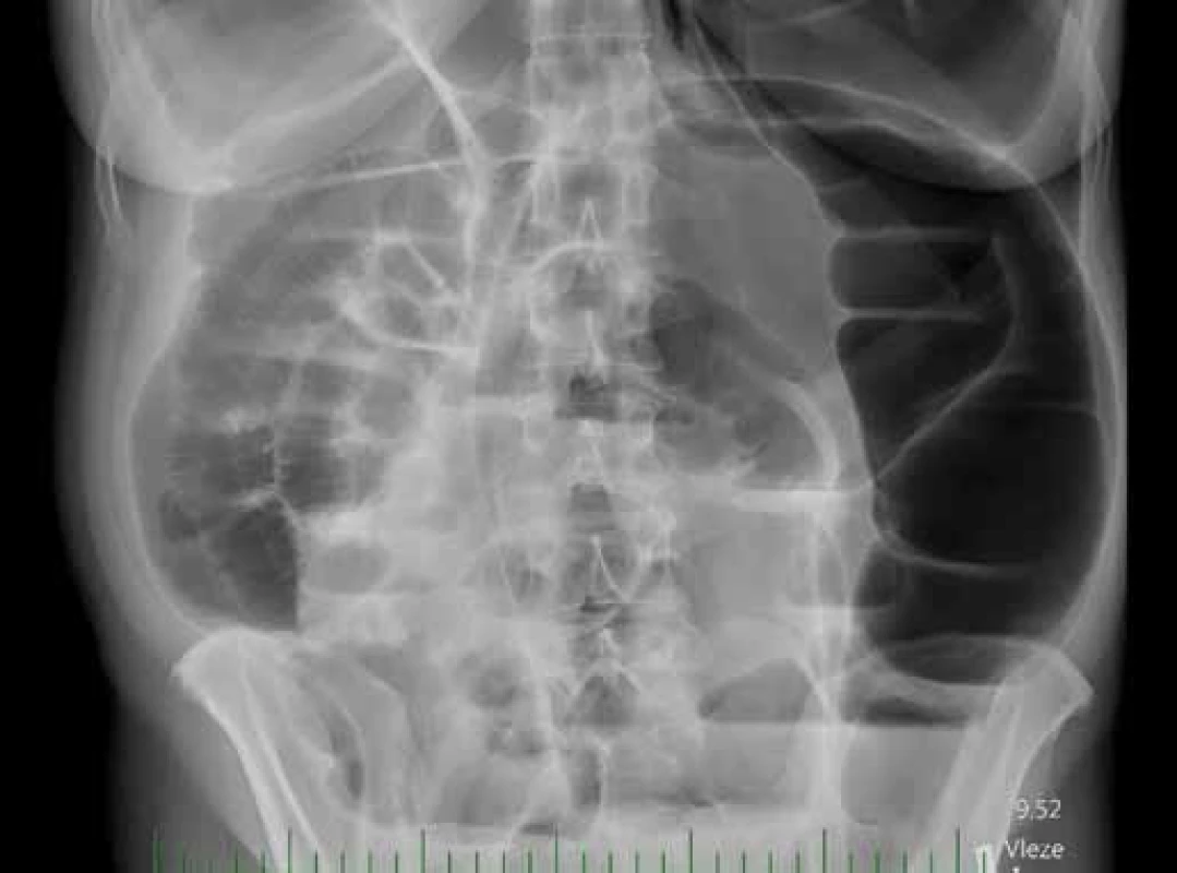 RTG břicha při přijetí.
Fig. 1. Abdominal X-ray on admission.