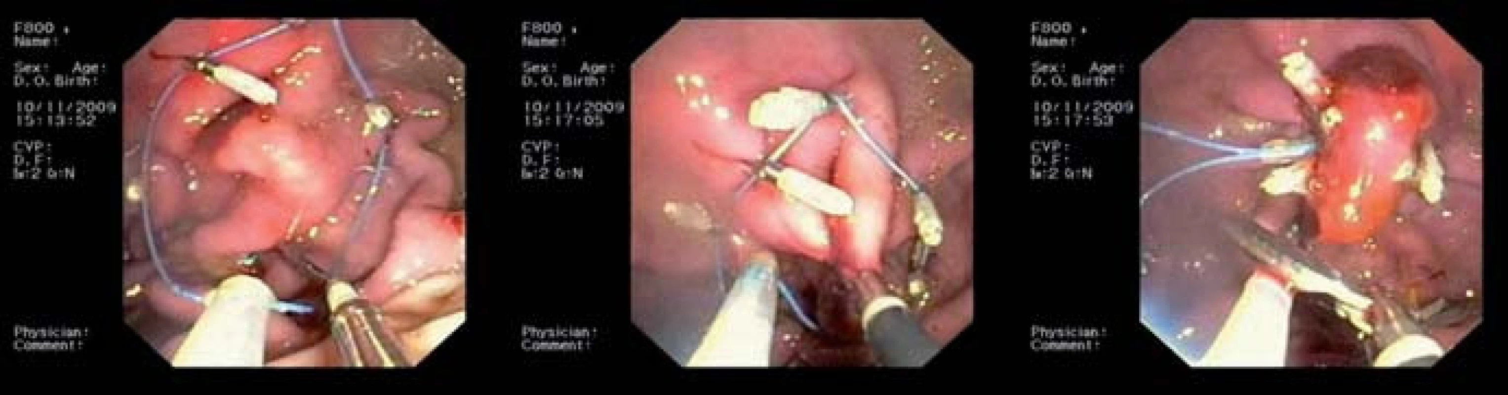 KING closure – technika uzávěru defekt  v GIT pomocí endoloopu a klip.
Fig. 5. KING closure – technique of defects closure in the GIT using an endoloop and clips.