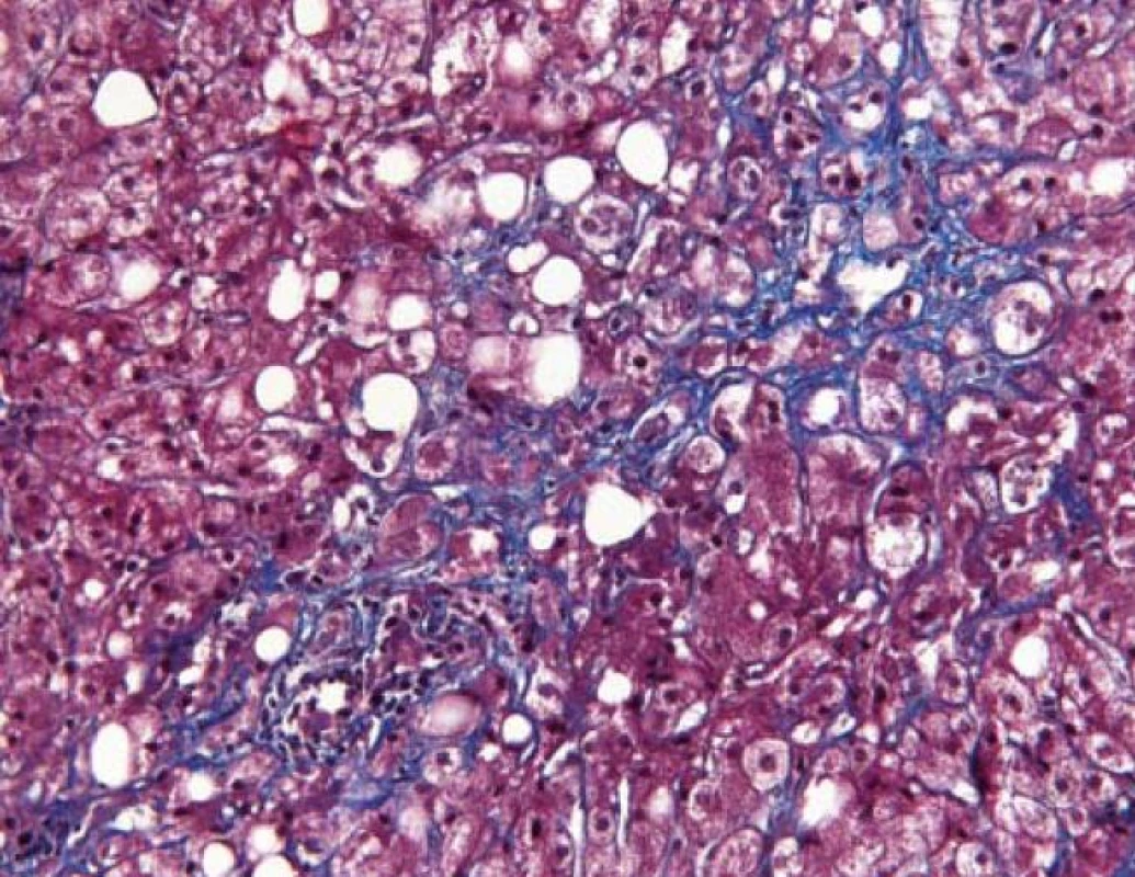 Histologický preparát jater s těžkou fibrózou etylické etiologie. Optický mikroskop, zvětšení 20×, numerická apertura 0,4. Barvení modrým trichómem dle Massona. Obrázek laskavě poskytnul MUDr. Jan Stříteský, Ústav patologie 1. LF UK a V FN v Praze.<br>
Fig. 1. Liver with severe fibrosis of ethylic etiology. Optic microscope, 20×, numeric aperture 0.4. Staining: blue trichrome, Masson. Photo by MUDr. Jan Stříteský, Department of pathology, First faculty of medicine, Charles University and VFN, Prague.