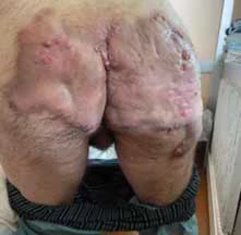 Gluteálny fenotyp HS. //  Gluteal HS phenotype.