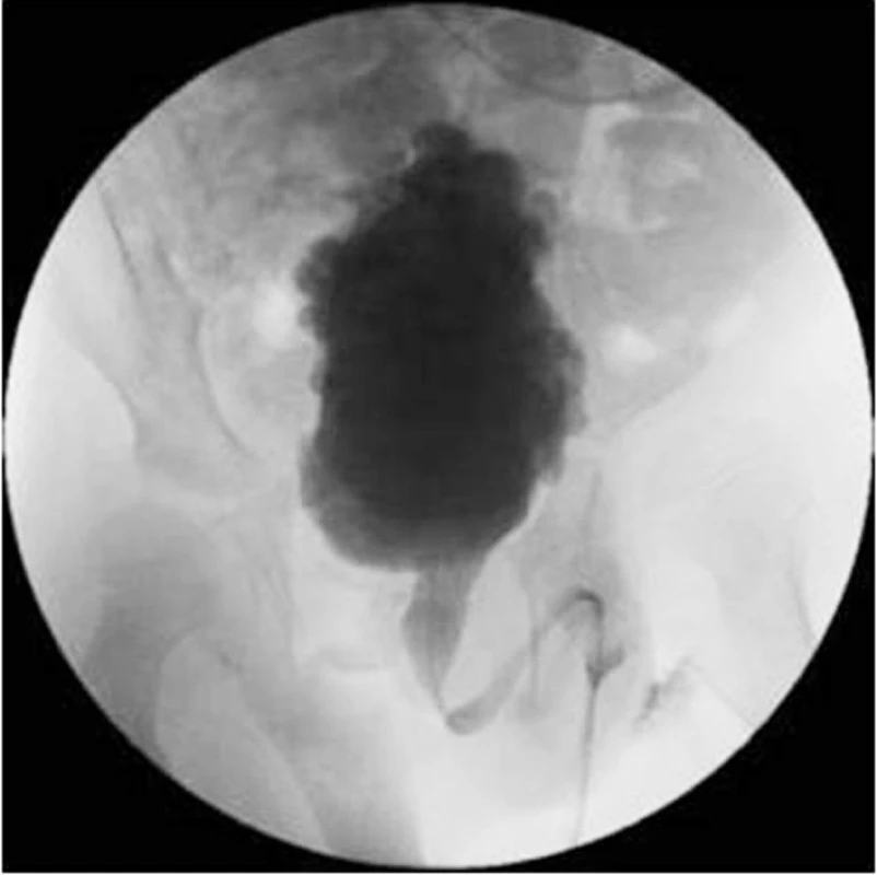 Vertikalizovaný, trabekulizovaný NM u osmiletého pacienta s DSD.
Fig. 5. Vertizalized, trabeculized NM in an eight-year boy with DSD.