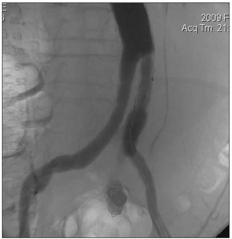 Dobrý efekt extenze levého raménka stentgraftu (bez endoleaku)
Fig. 3. Agood effect of left branch extension of stentgraft (no endoleak)