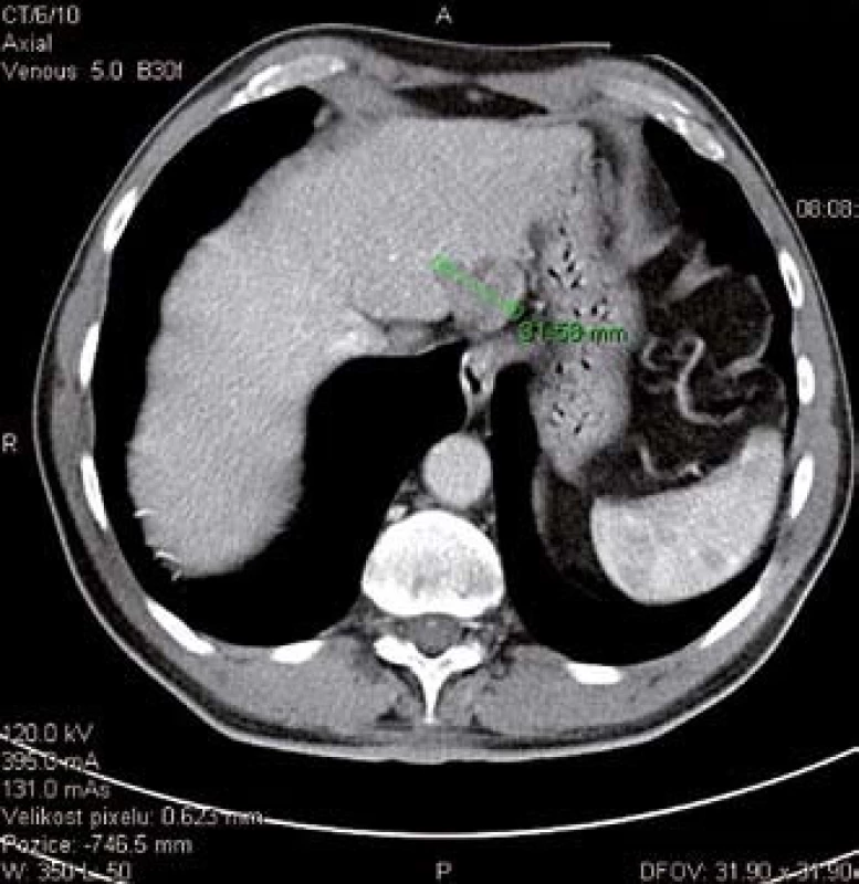 CT snímek HCC v levém jaterním laloku.
Fig. 1. CT scan of HCC in left liver lobe.
