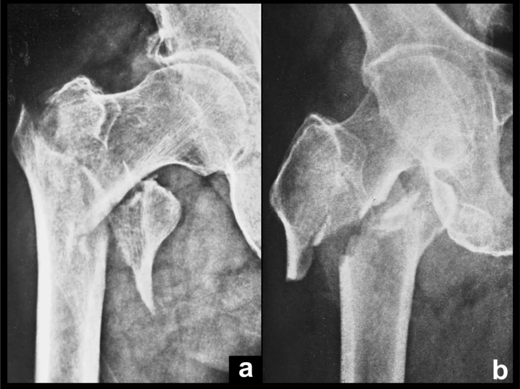 Trochanterické zlomeniny: a – nestabilní pertrochanterická zlomenina s typickými třemi hlavními fragmenty, z nichž dorzální je rozlomen na dvě části; b – intertrochanterická třífragmentová zlomenina, dorzální fragment však není příliš patrný.
Fig. 5: Trochanteric fractures: a – an unstable pertrochanteric fracture with typical three main fragments, of which the posterior one is split into two parts; b –an intertrochanteric threefragment fracture, the posterior fragment, however, cannot be clearly seen.