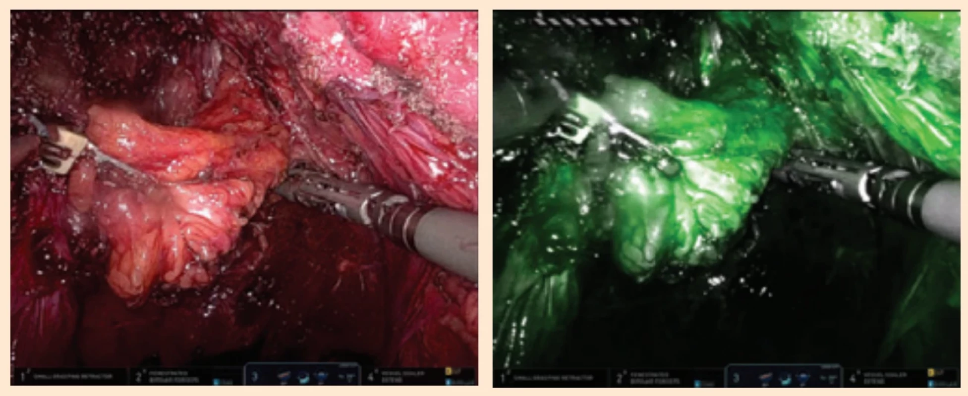 Mesorectum in visible light and NIR (near infra red). Obr. 3. Mesorektum ve viditelném světle a v NIR (near infra red) zobrazení.