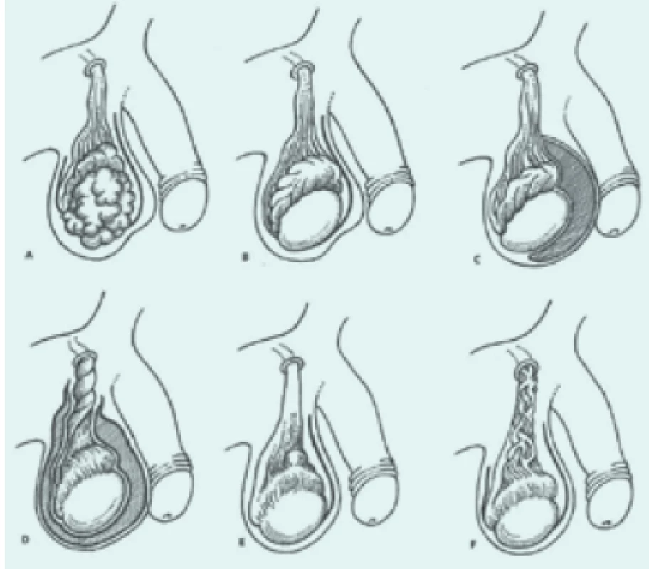 Věkové rozložení seminomů (a) a germinálních nádorů neseminomového typu (b) podle materiálu Onkologické kliniky 1. LF UK a TN. Vrchol výskytu NSGCT je oproti seminomům posunut o jedno decénium k mladším věkovým kategoriím.
