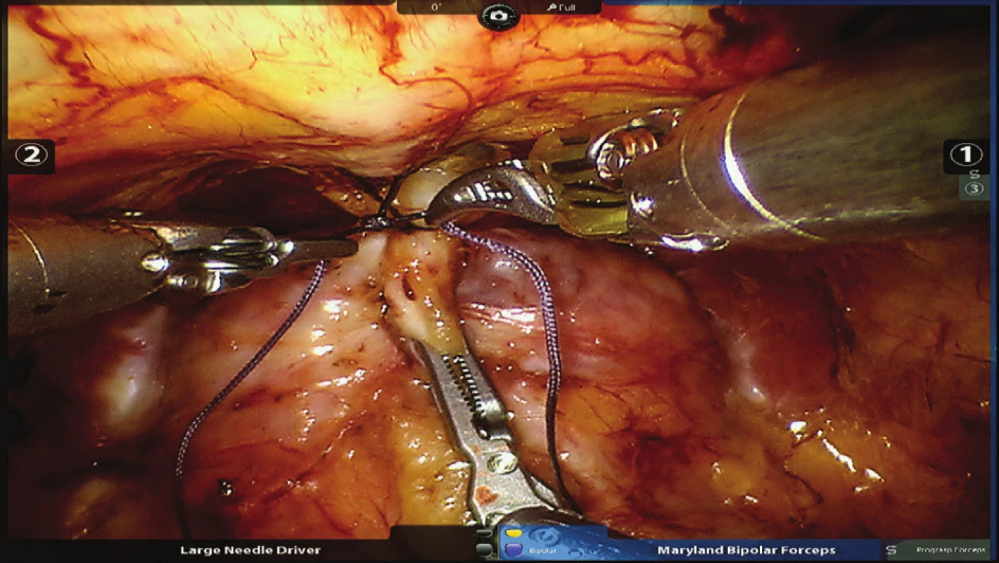 Podvaz komplexu dorzální žíly s fixací ke sponě
Fig. 1: Ligation of the dorsal venous complex with its fixation to the pubic bone