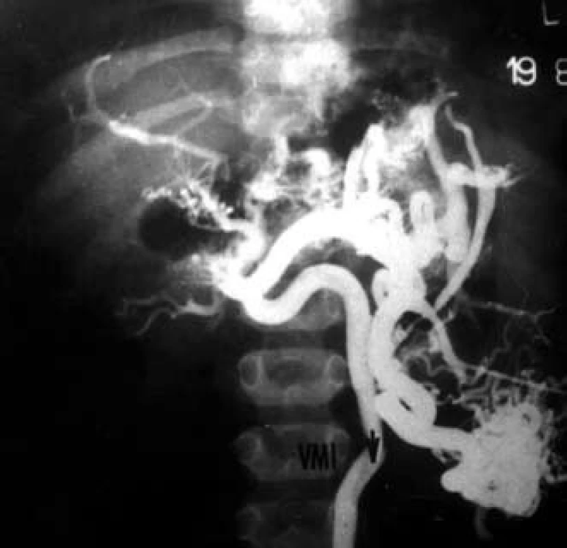 Distálna trombóza VL s kolaterálnym riečiskom cez dolnú mezenterickú vénu [11].
Fig. 2. Distal thrombosis of VL with collaterals through the lower mesenteric vein [11].