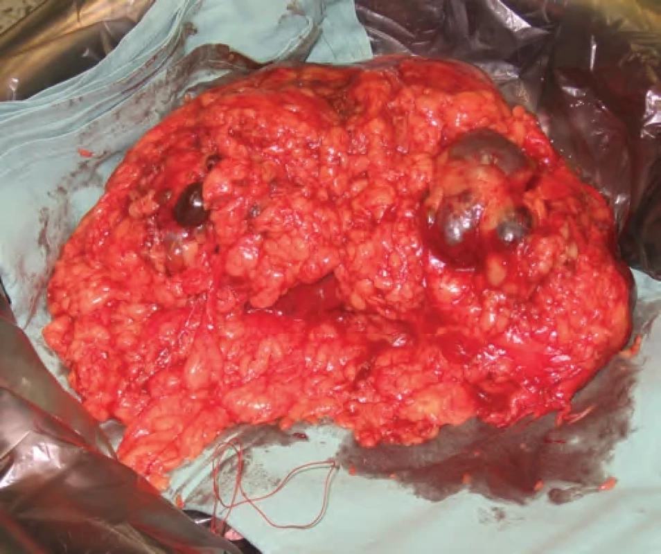 Preparát polycystické ledviny. Fig. 1. Polycystic kidney specimen.