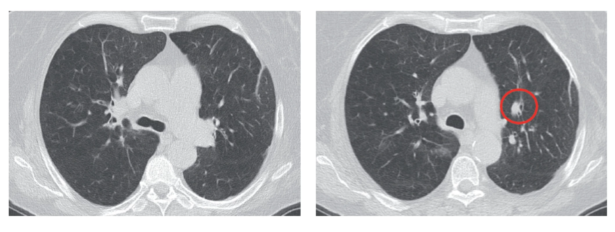 CT scans showing regression of the original infiltration on the right, with only residual involvement in the hilum area, whereas in the upper lobe the findings have fully regressed and the metastasis on the left has reduced