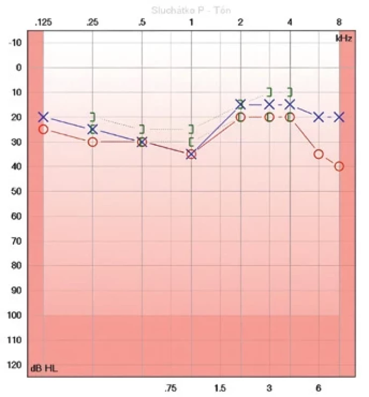 Audiogram, únor 2024.  Fig. 1. Audiogram, February 2024.