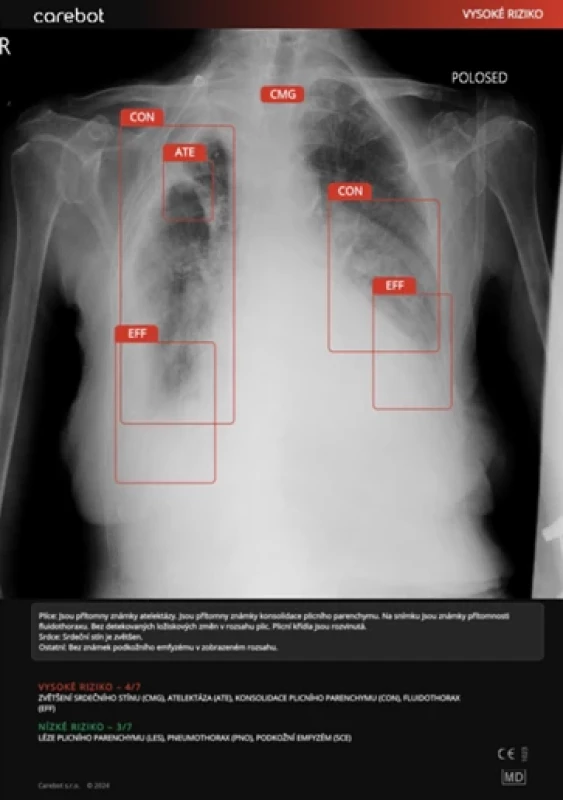 Příklad skutečně pozitivní predikce AI: Původní popis verifikovaný seniorním radiologem potvrzuje přítomnost apikalizace hilů, chronického zastření, zvětšení srdečního stínu a oboustranného pleurálního výpotku. AI správně identifikovala všechny uvedené patologické stavy jako „vysoké riziko“. Z radiologů v multi-reader studii označil všechny 4 nálezy správně pouze RAD 3, zatímco RAD 1 a RAD 2 hodnotili jednotlivé nálezy částečně nebo nesprávně. 