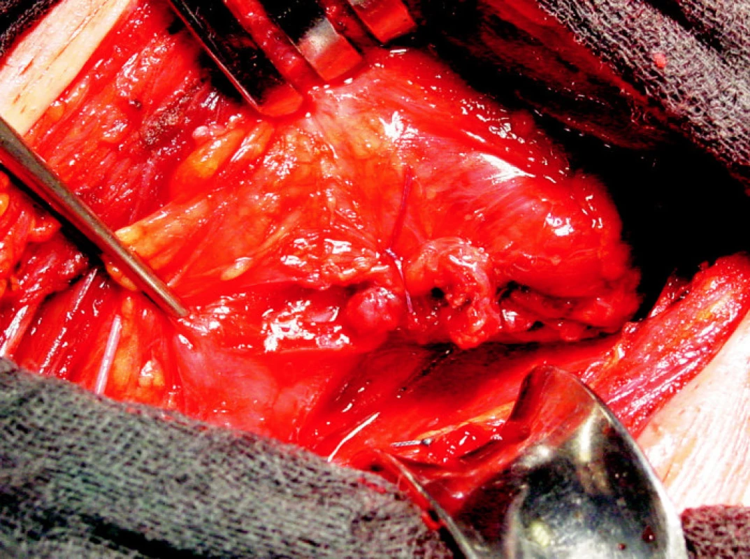 Sutura jícnu po resekci Zenkerova divertiklu
Fig. 4. Suture of the esophagus following the Zenker’s diverticle resection