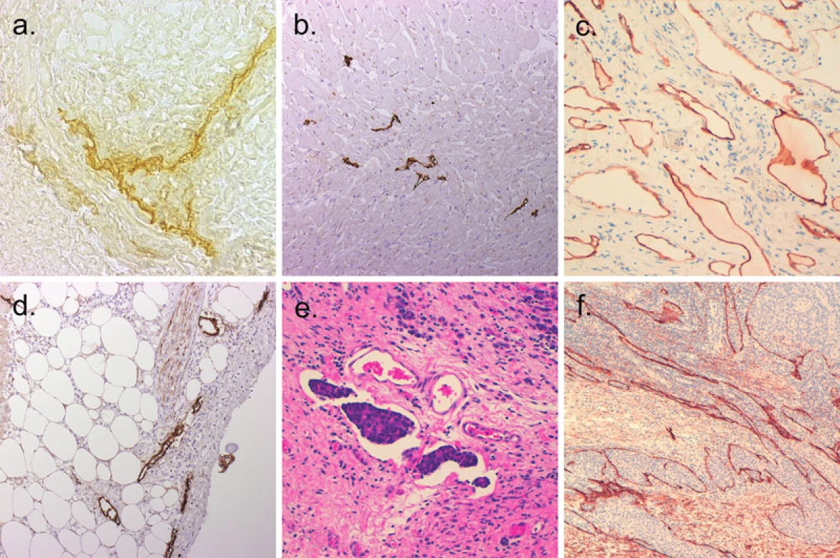 Lymfatické cévy v různých normálních a patologicky změněných tkáních. 
a. Lymfatická kapilára v myším jazyku detekovaná histochemicky ceriovou reakcí na 5’nukleotidázu (400krát); b. Lymfatické cévy v normálním myokardu lidského srdce; imunohistochemická reakce s protilátkou D2-40 (100krát); c. Jejunální lymfangiom vykazuje podoplanin imunopozitivitu v lymfatických cévách (200krát); d. Zvýšené množství lymfatik v perikardu postiženém perikarditidou; imunohistochemická reakce s protilátkou D2-40 (100krát); e. Šíření nádorových buněk adenokarcinomu žaludku lymfatickými cévami (HE, 200krát); f. Intratumorální lymfatické cévy v adenokarcinomu tlustého střeva; imunohistochemická reakce s protilátkou proti podoplaninu (100krát)