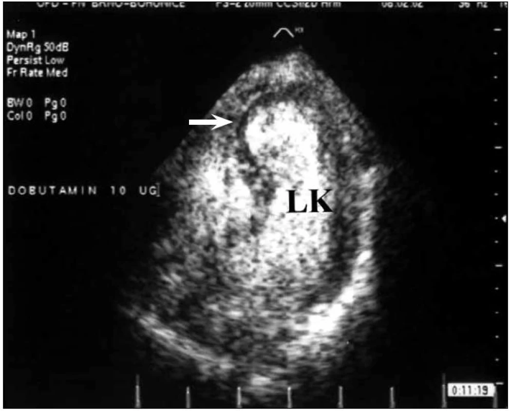 Aneuryzma hrotu LK. Dutina LK vyplněna kontrastní látkou.
LK – levá komora