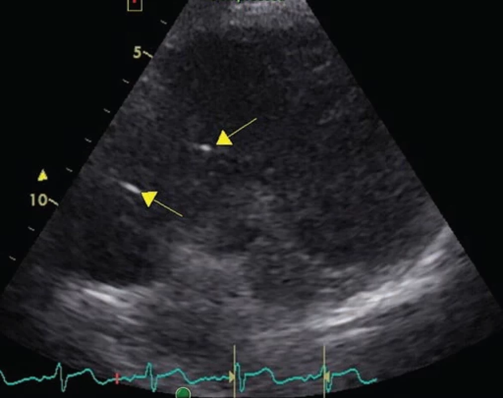 Transthoracic echocardiography guided shunt-o-gram.