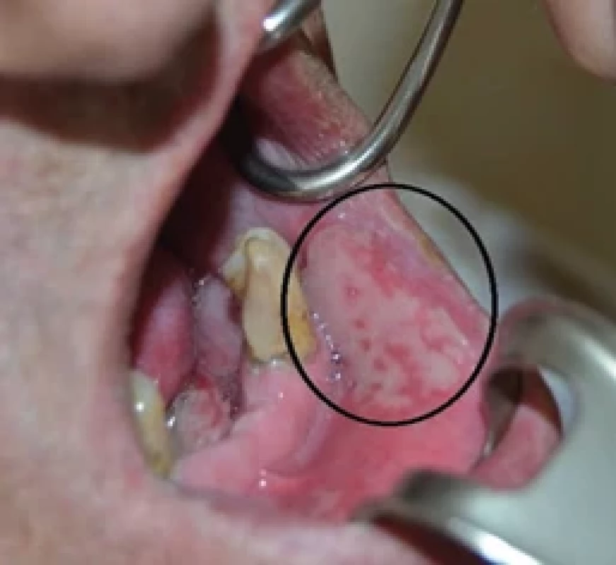 Diff use erosion, more than 1.5 cm covered with fi brinous plaque – grade III radiation mucositis.