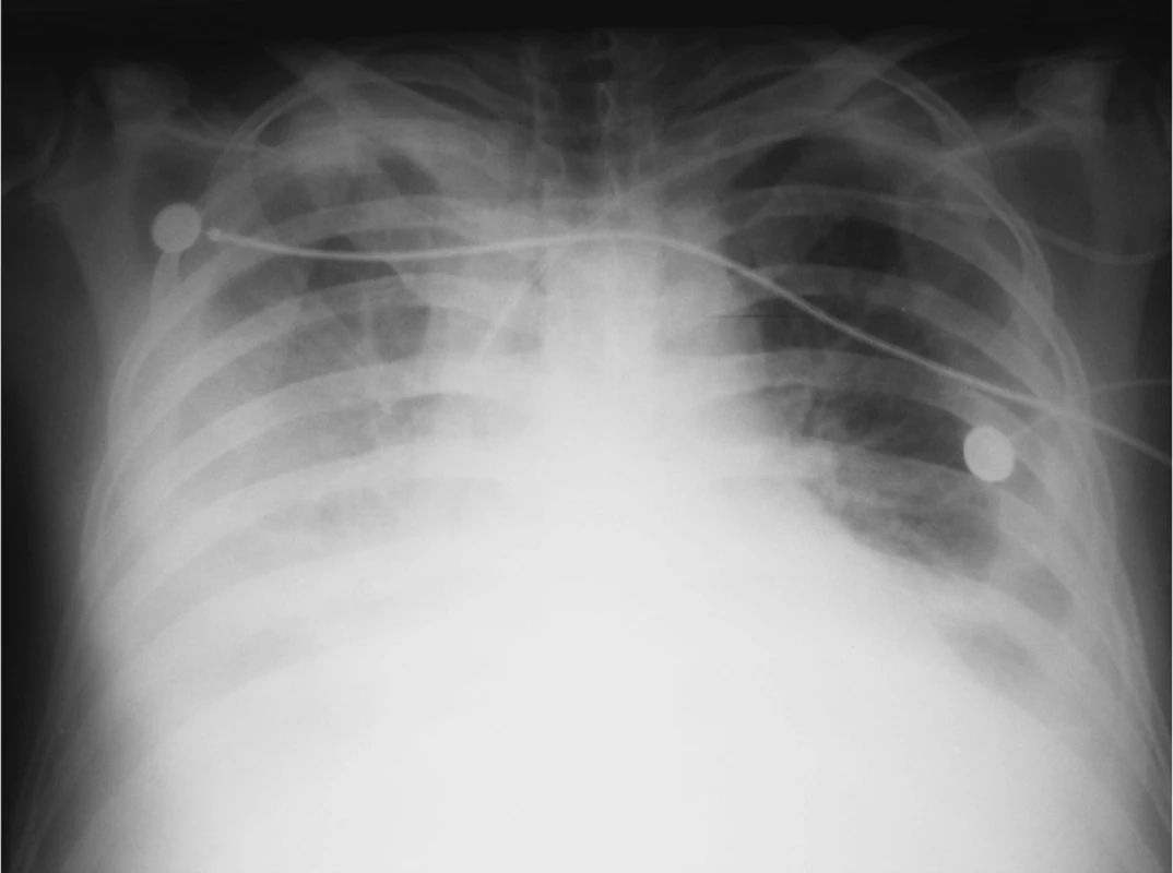  RTG plic – oboustranný fluidotorax
Fig. 2. Pulmonary x-ray – bilateral fluidothorax