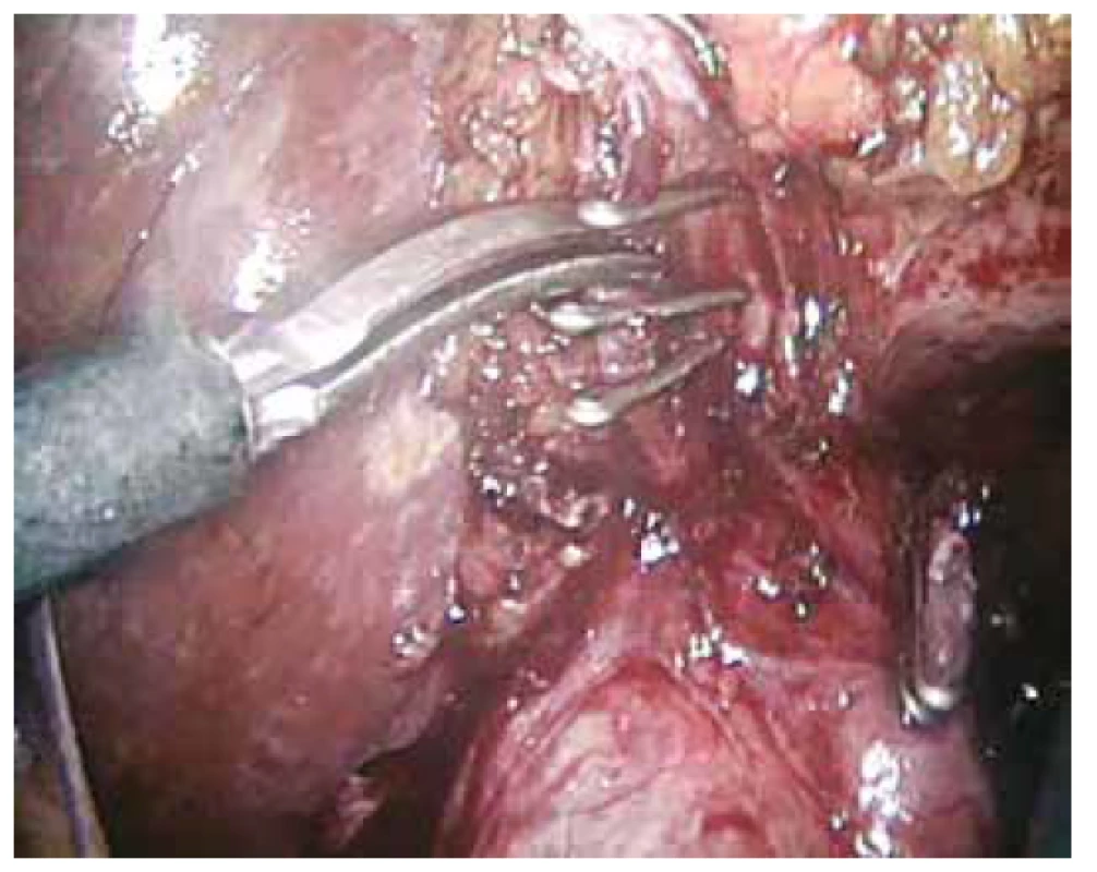 Ligace a střižení a. cystica, ductus cysticus ligován<br>
Fig. 4: Clipping and cutting of the cystic artery, cystic duct
clipped