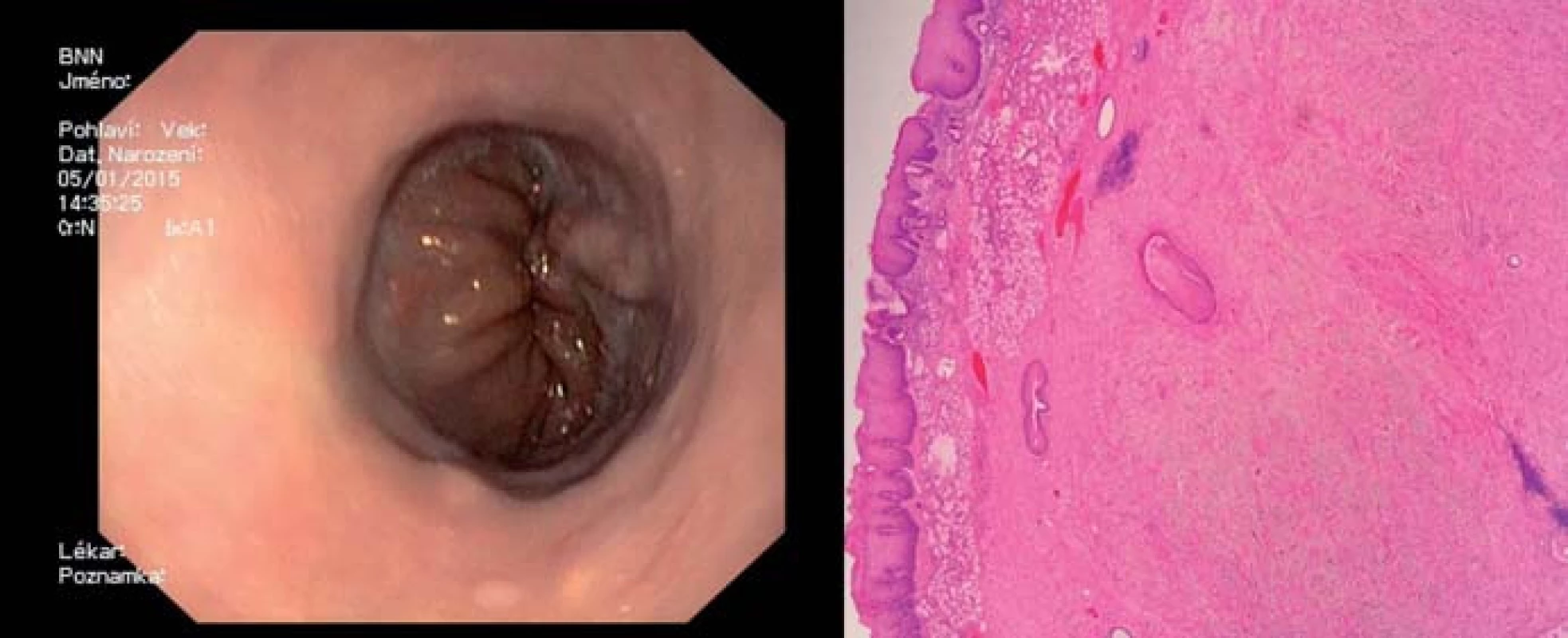 Stejná pacientka tři měsíce po výkonu a histologický obrázek fibromu.
Fig. 12. The same patient three months after surgery and a histological image of the fibroma.