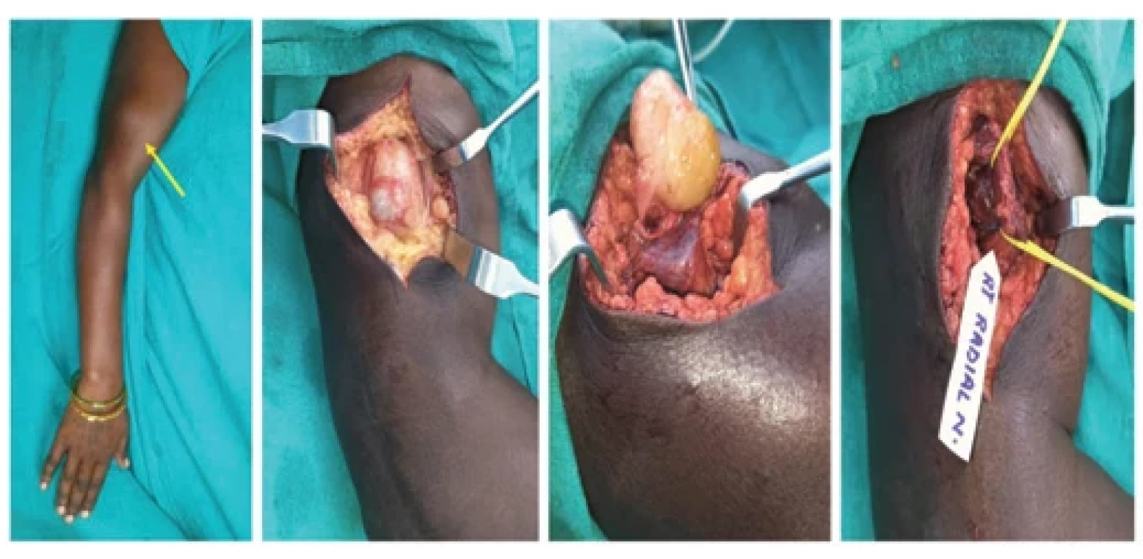 Schwannoma arising from the right side main radial nerve. On exploration, the tumor was found to be encasing entire nerve fascicle. Hence, the tumor was completely removed by intracapsular enucleation with preservation of complete function of radial nerve.