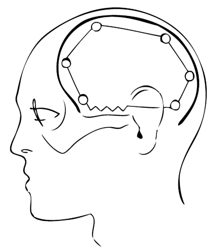 Kožní řez tvaru „omega“
Pic. 5. “Omega“ shaped skin section