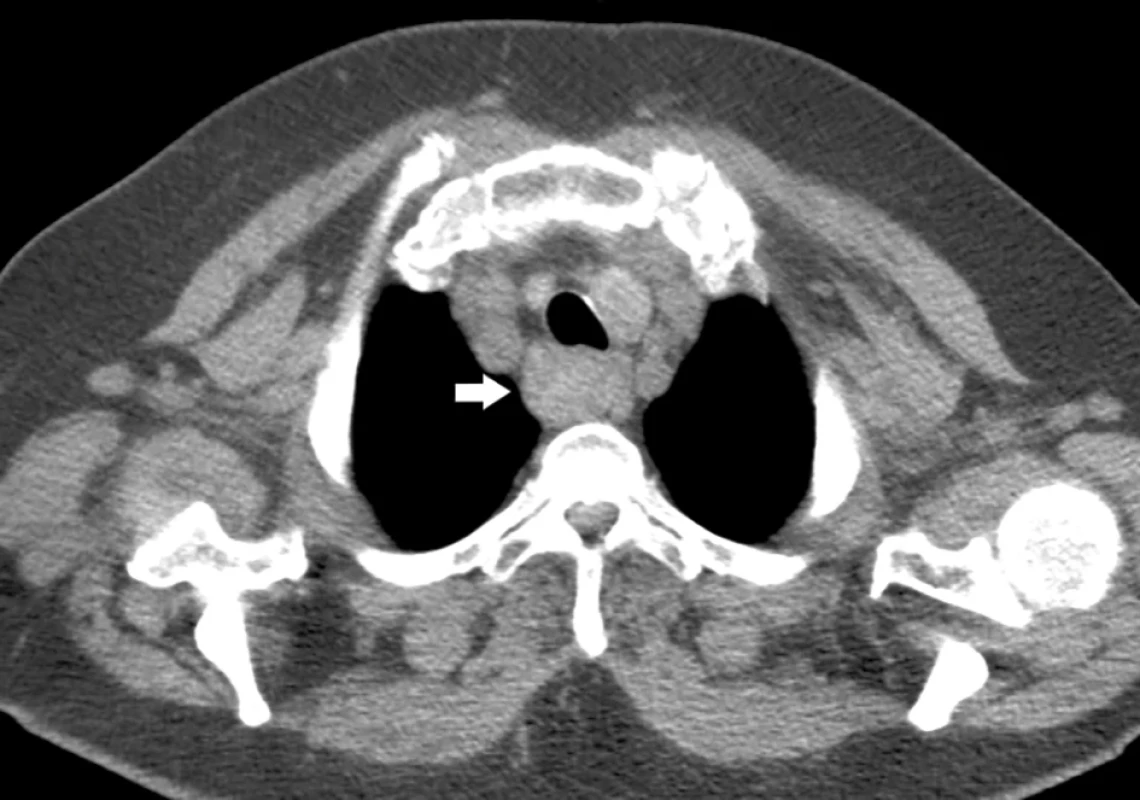 CT – transverzální řez   Fig. 1: CT – transverse section