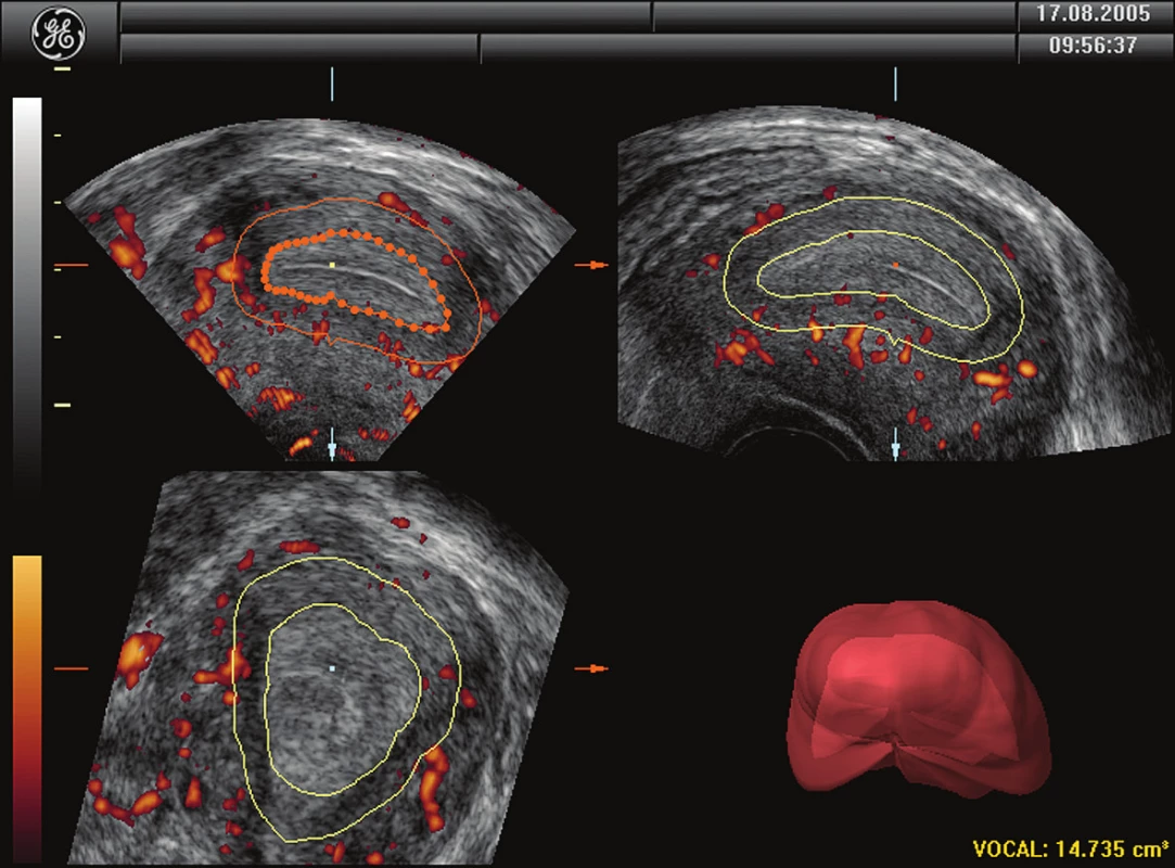 Zobrazení subendometriálního objemu pomocí rotační metody programu VOCAL ve 3 na sebe kolmých rovinách. Horní vlevo reprezentuje zobrazení v longitudiální rovině, horní vpravo zobrazení v transverzální rovině a dolní vlevo zobrazení v rovině koronální.