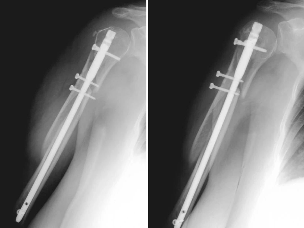 Migrace metafyzárních šroubů
a) stav po operaci
b) stav 3 měsíce po operaci
Pic. 6. Migration of metaphyseal screws
a) postsurgical condition
b) 3 months postsurgically